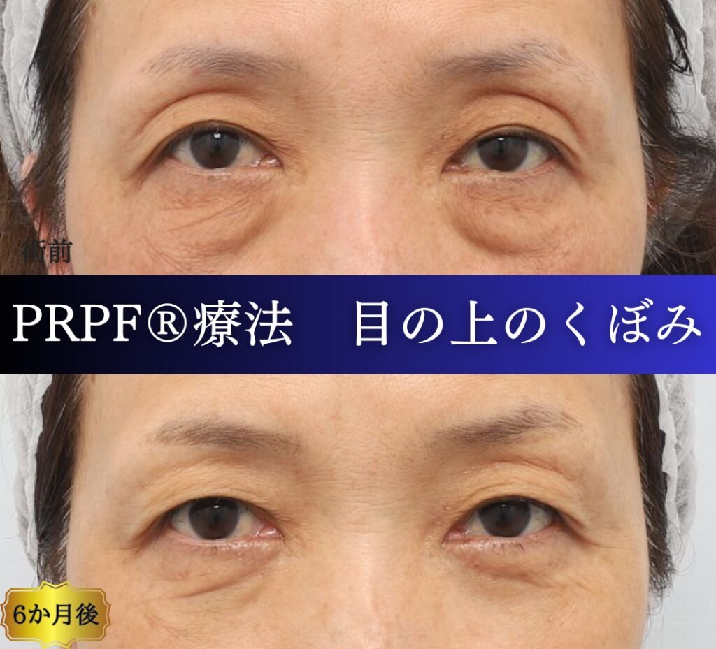 くぼみ目の改善、PRPF療法、50代の症例 (3)