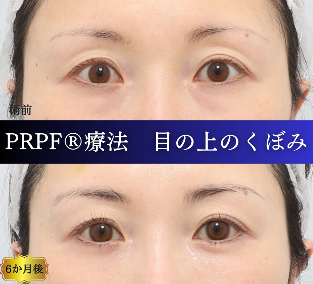 くぼみ目の治療、PRPF療法、40代女性の症例 (5)