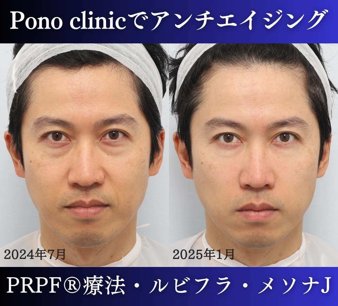 再生医療、PRPF®療法、メソナJ、ルビーフラクショナル、40代男性の症例