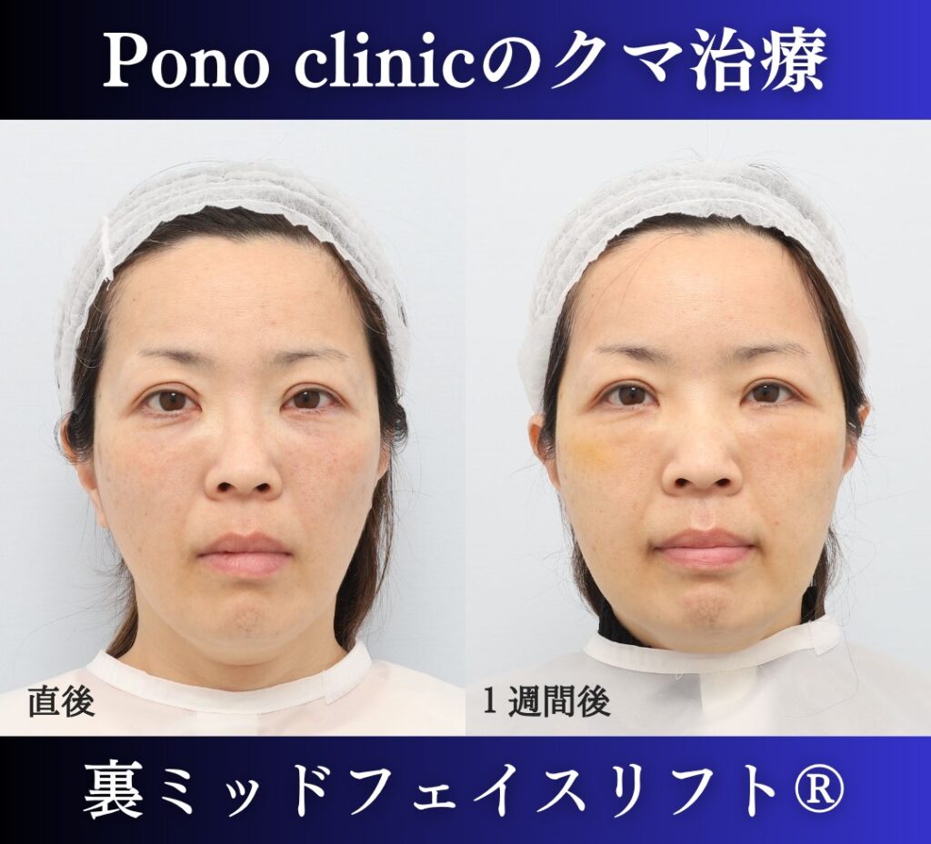 50代女性の症例、目の下のクマ取り、裏ミッドフェイスリフト、裏ハムラ (1)