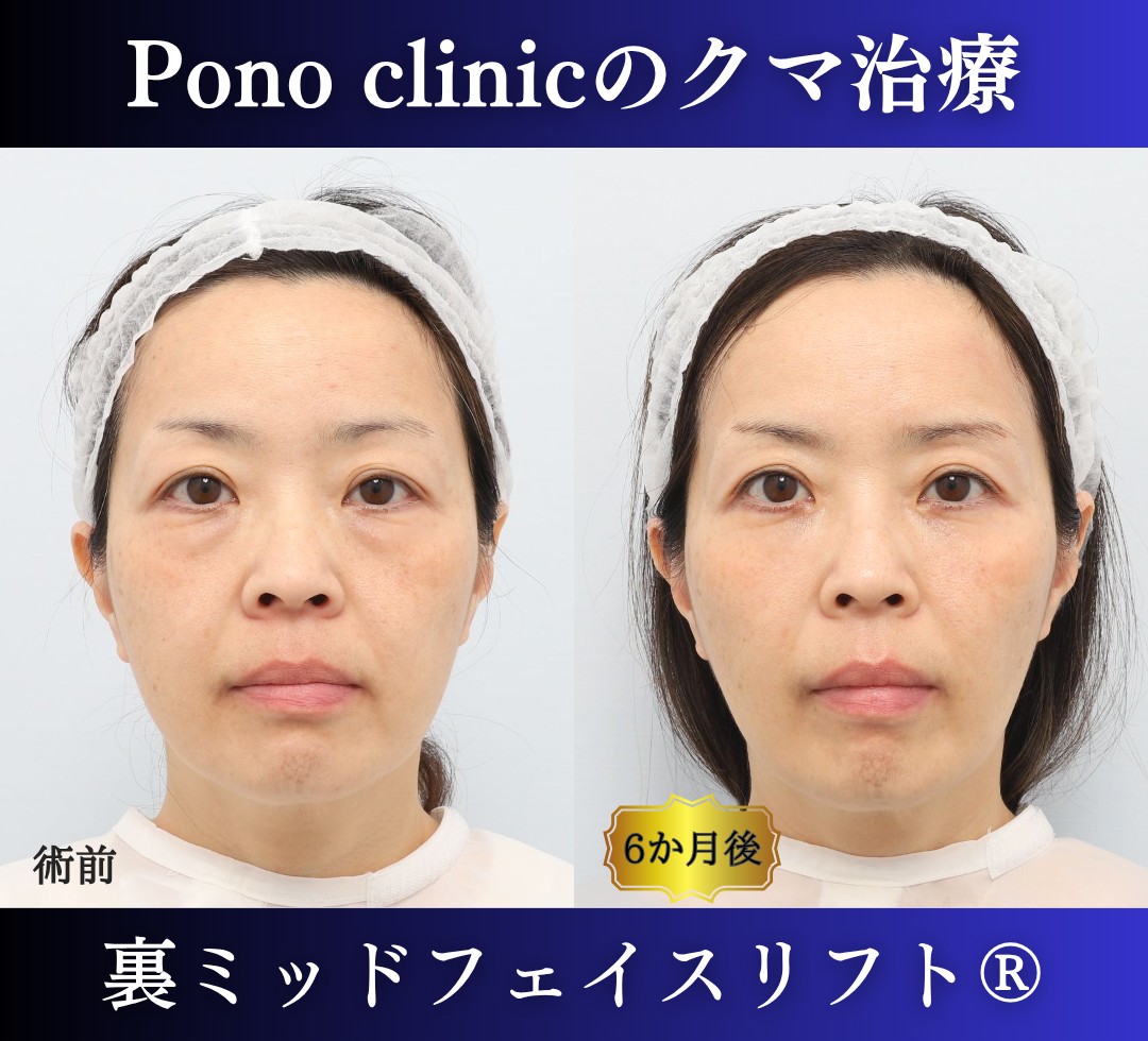 50代女性の症例、目の下のクマ取り、裏ミッドフェイスリフト、裏ハムラ (7)