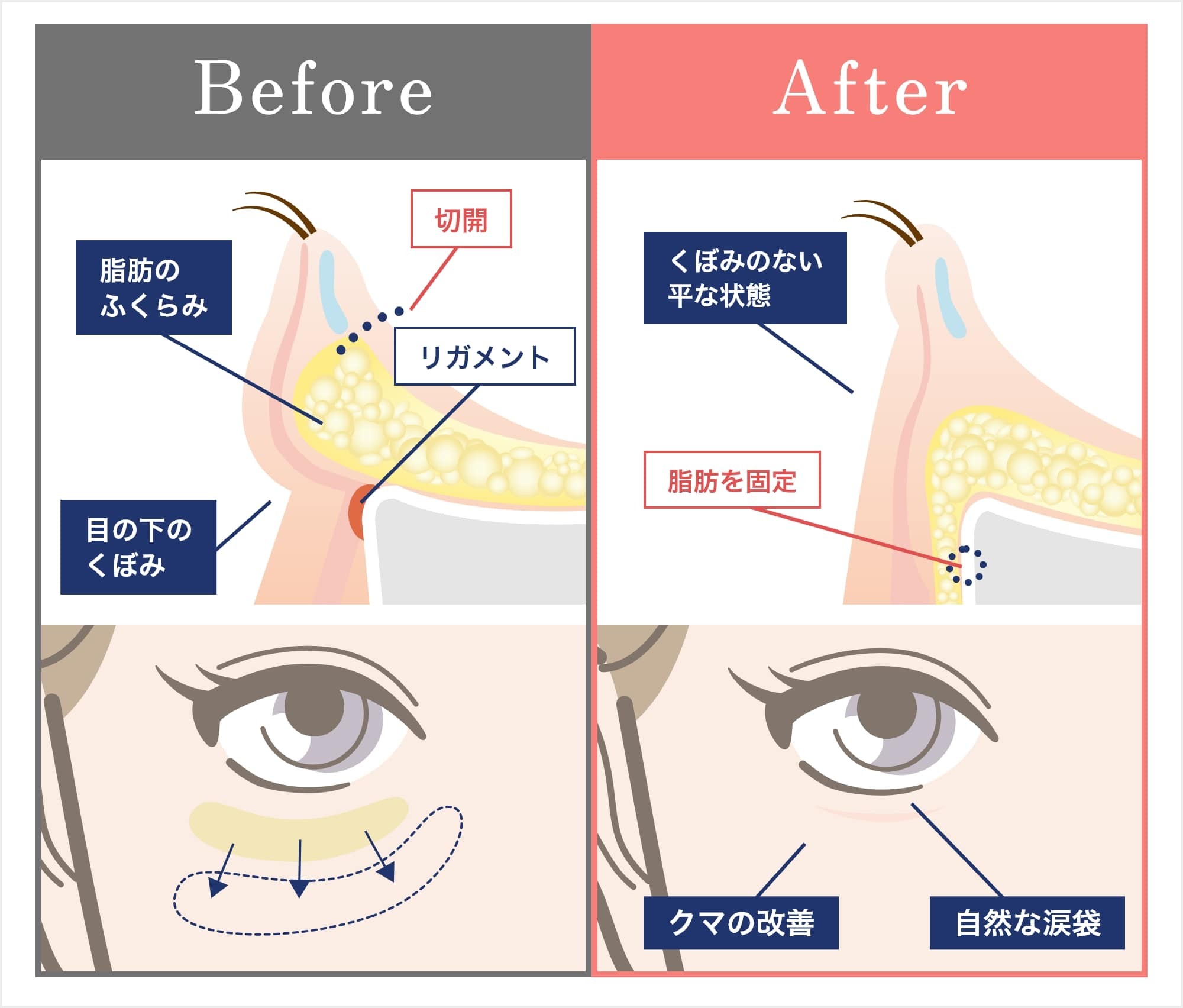 裏ハムラ・裏ミッドフェイスリフト