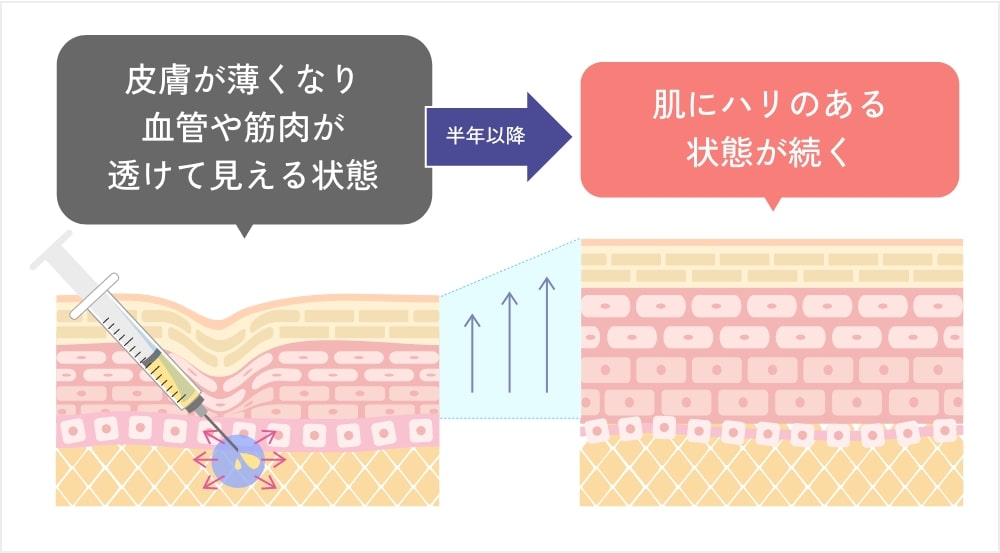 PRPF®療法