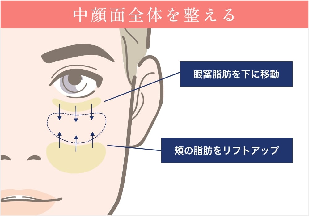 裏ミッドフェイスリフト®の解説