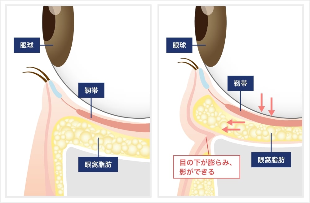 眼窩脂肪突出による影響の解説