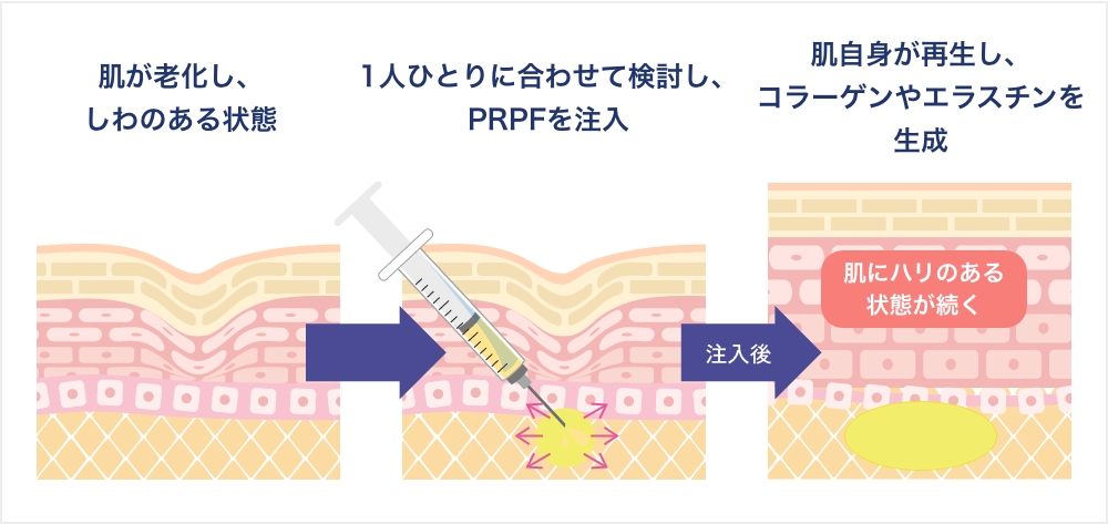 PRPF®療法の治療と効果