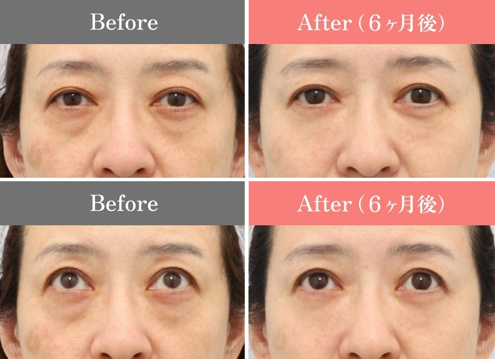 CASE01.裏ミッドフェイスリフト®、PRPF®療法(目の下)の症例