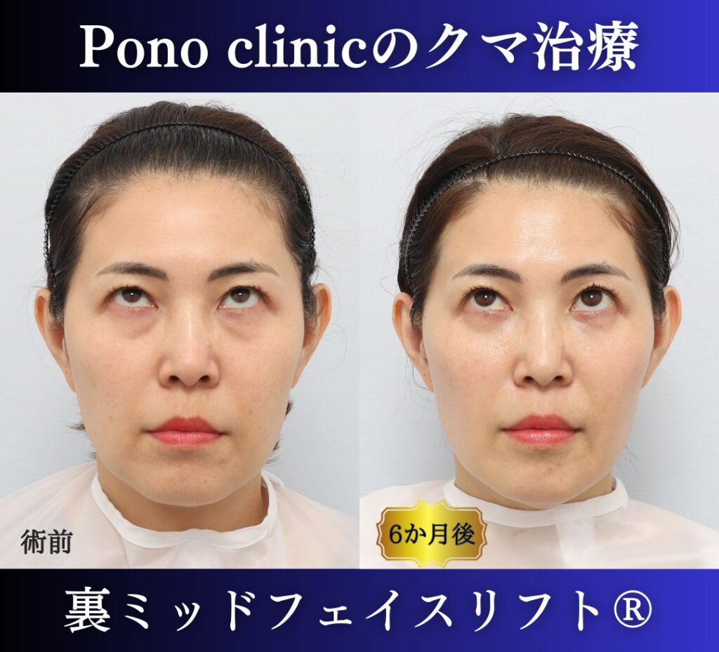 40代の症例、目の下のクマ取り、裏ハムラ法、ミッドフェイスリフト (5)