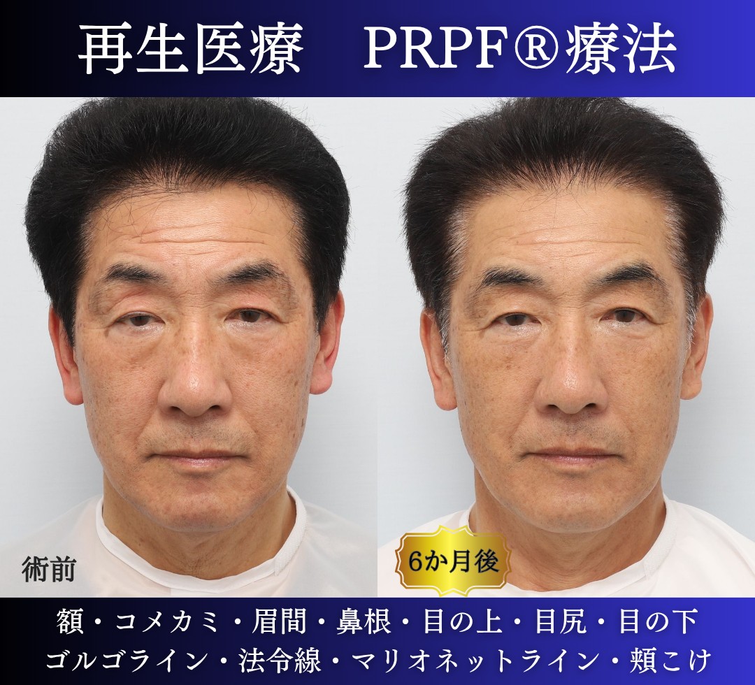 60代男性の症例、若返り治療、PRPF療法、法令線治療、しわ取り