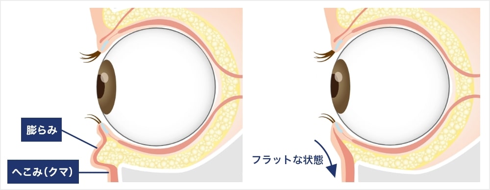 裏ハムラ法