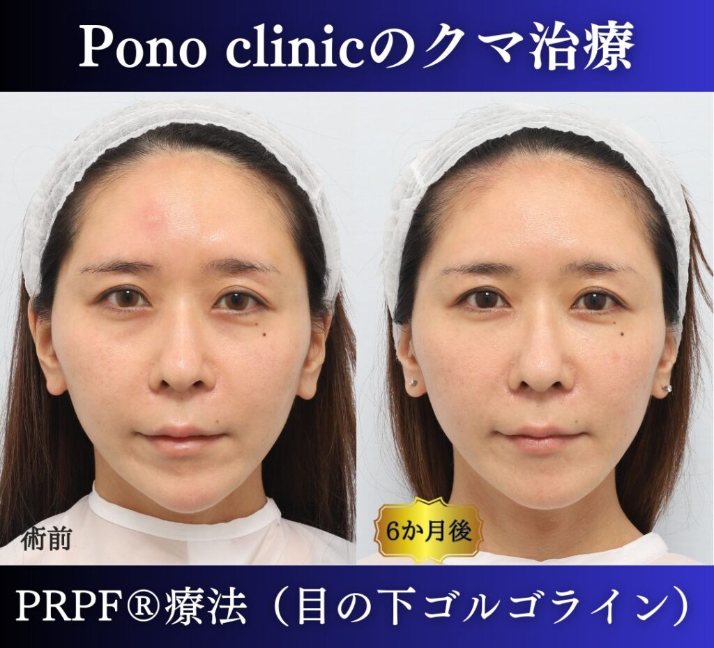 30代女性の症例、目の下のクマ、切らないクマ取り、再生医療、クマ取り注射 (7)