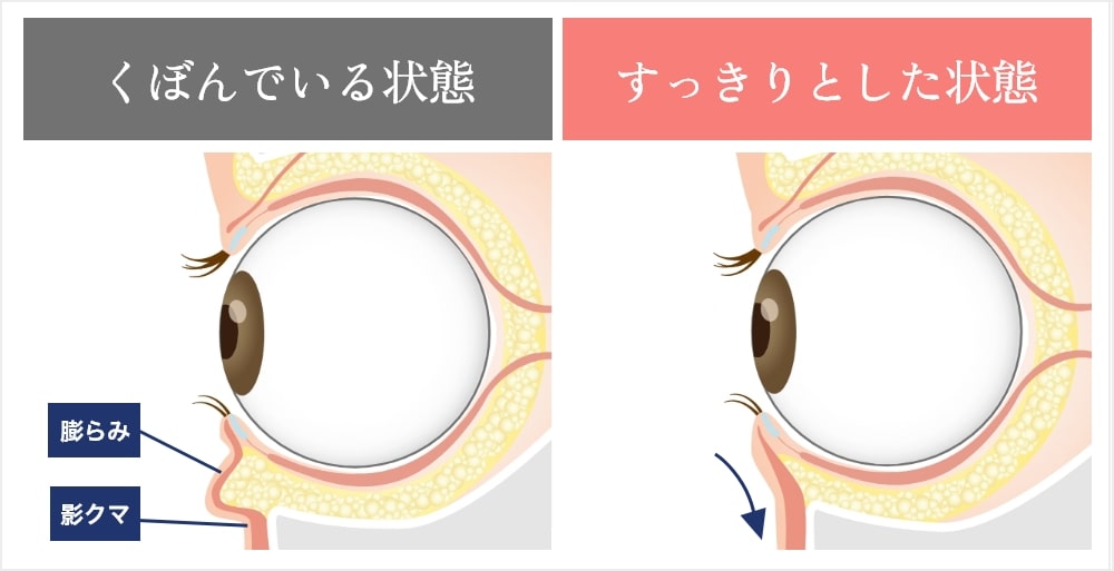 裏ハムラ