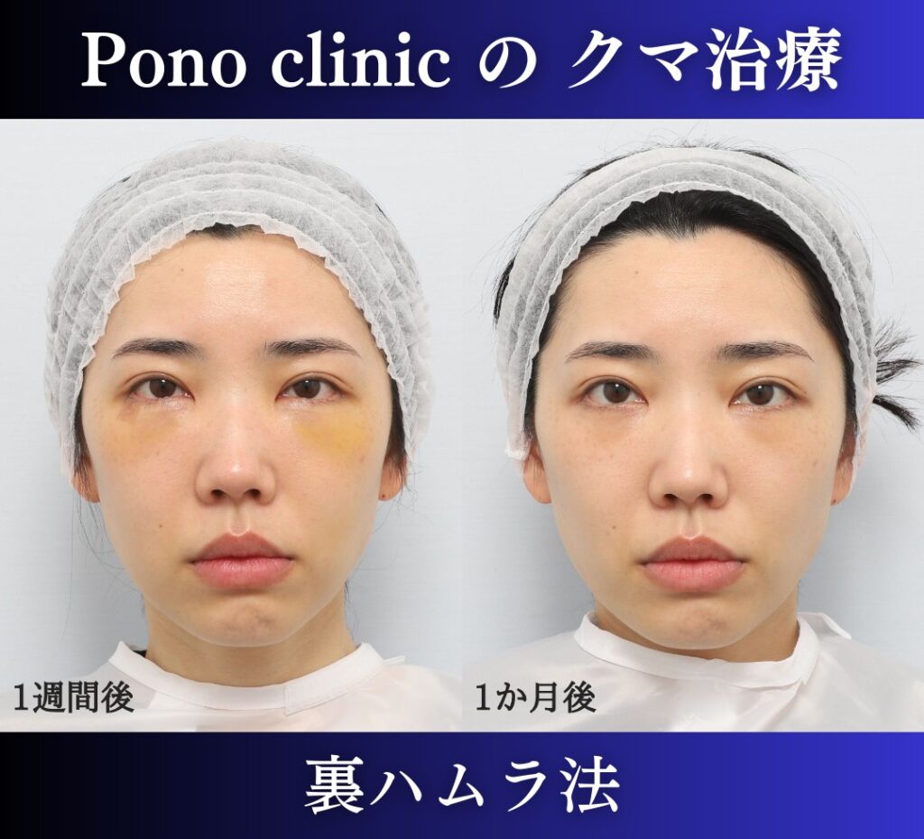 30代女性の症例、目の下のクマ取り、裏ハムラ、目の下のクマ改善 (1)