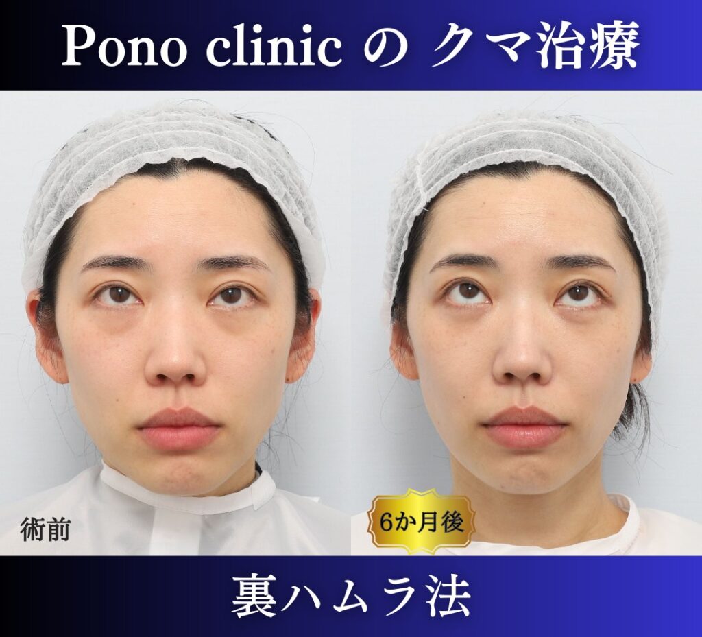 30代女性の症例、目の下のクマ取り、裏ハムラ、目の下のクマ改善 (5)