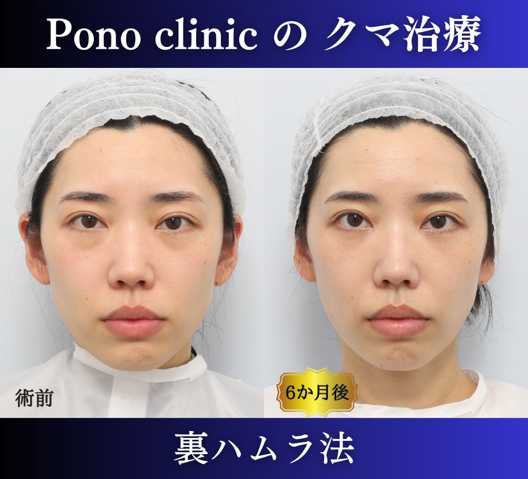 30代女性の症例、目の下のクマ取り、裏ハムラ、目の下のクマ改善 (7)