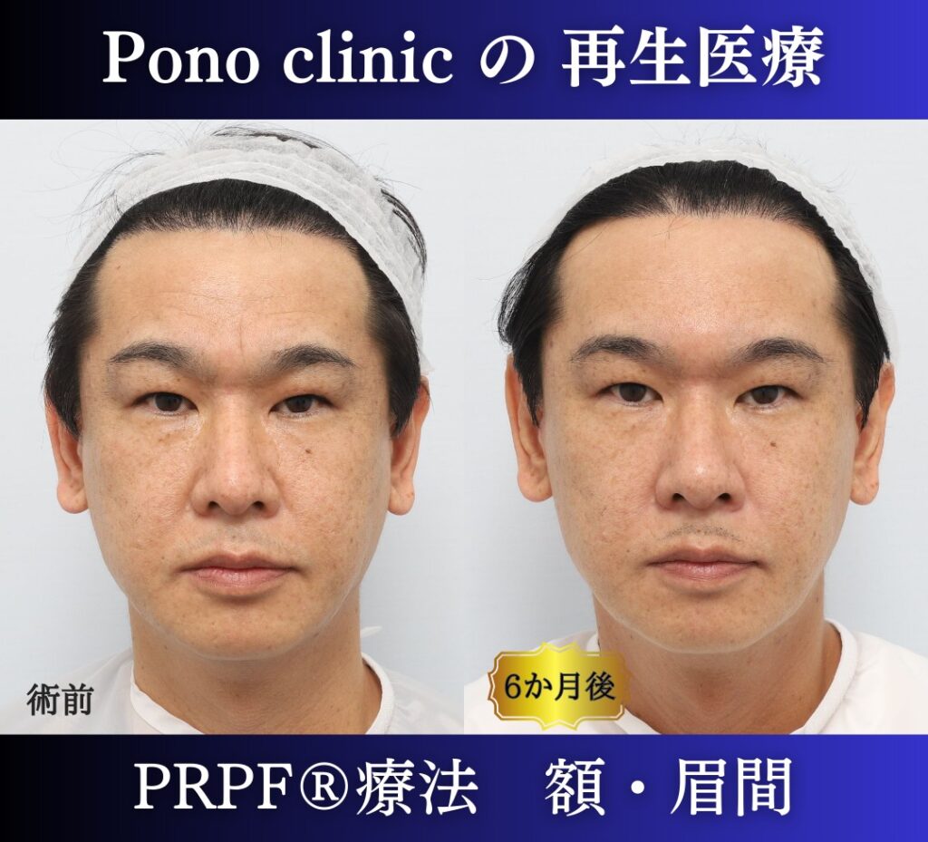 しわ取り、しわ治療、眉間のしわ、額のしわ、40代男性の症例 (5)