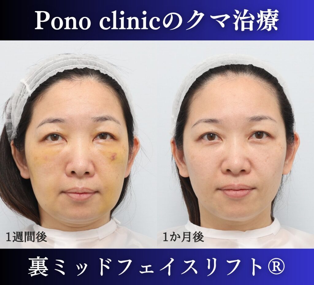 40代女性、目の下のクマ、裏ハムラ法、クマ取り 新宿、裏ミッドフェイスリフト (1)