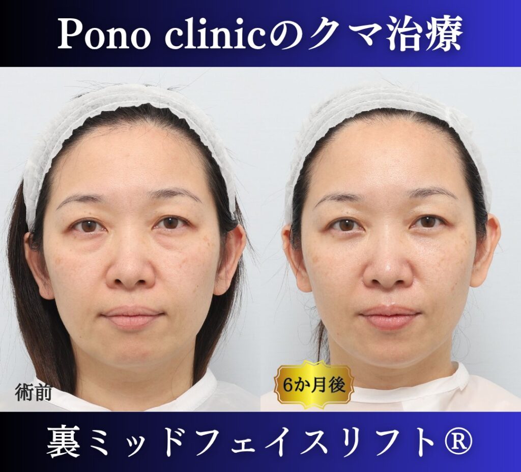 40代女性、目の下のクマ、裏ハムラ法、クマ取り 新宿、裏ミッドフェイスリフト (7)