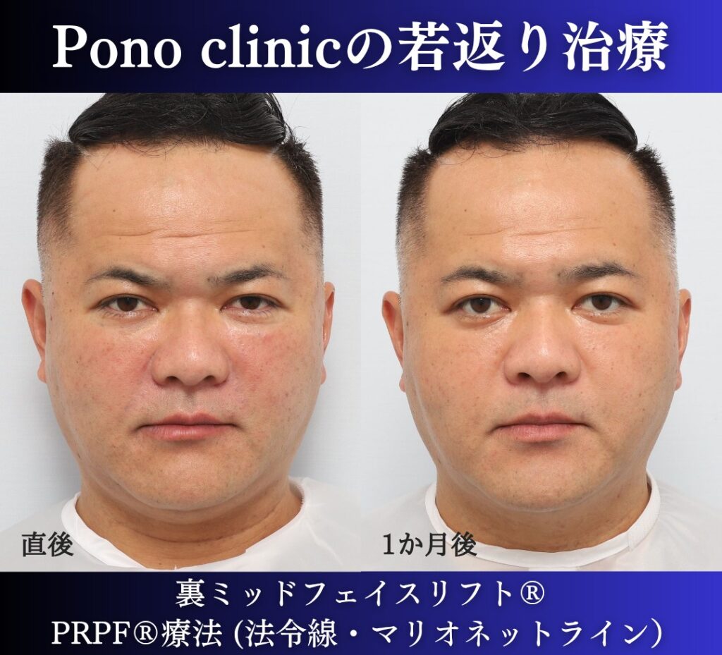 40代男性、クマ取り、しわ取り、法令線治療、裏ハムラ、裏ミッドフェイスリフト、PRP (1)