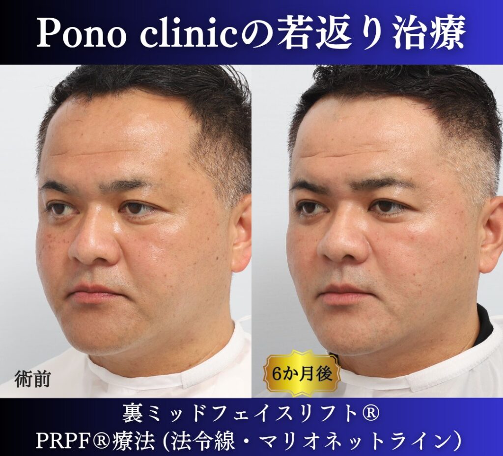 40代男性、クマ取り、しわ取り、法令線治療、裏ハムラ、裏ミッドフェイスリフト、PRP (3)