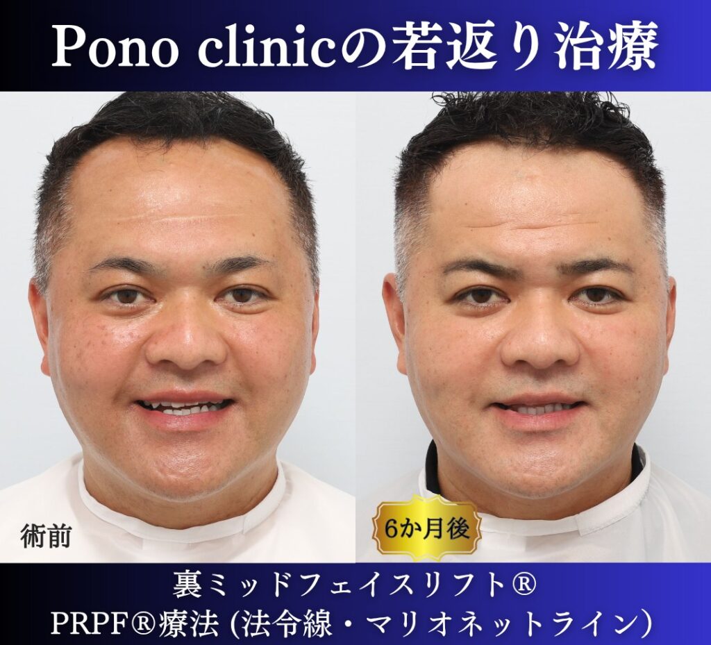 40代男性、クマ取り、しわ取り、法令線治療、裏ハムラ、裏ミッドフェイスリフト、PRP (4)