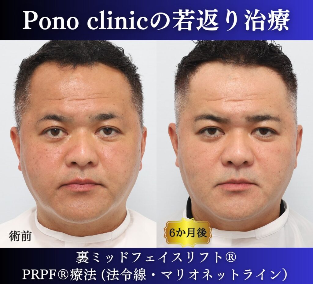40代男性、クマ取り、しわ取り、法令線治療、裏ハムラ、裏ミッドフェイスリフト、PRP (7)