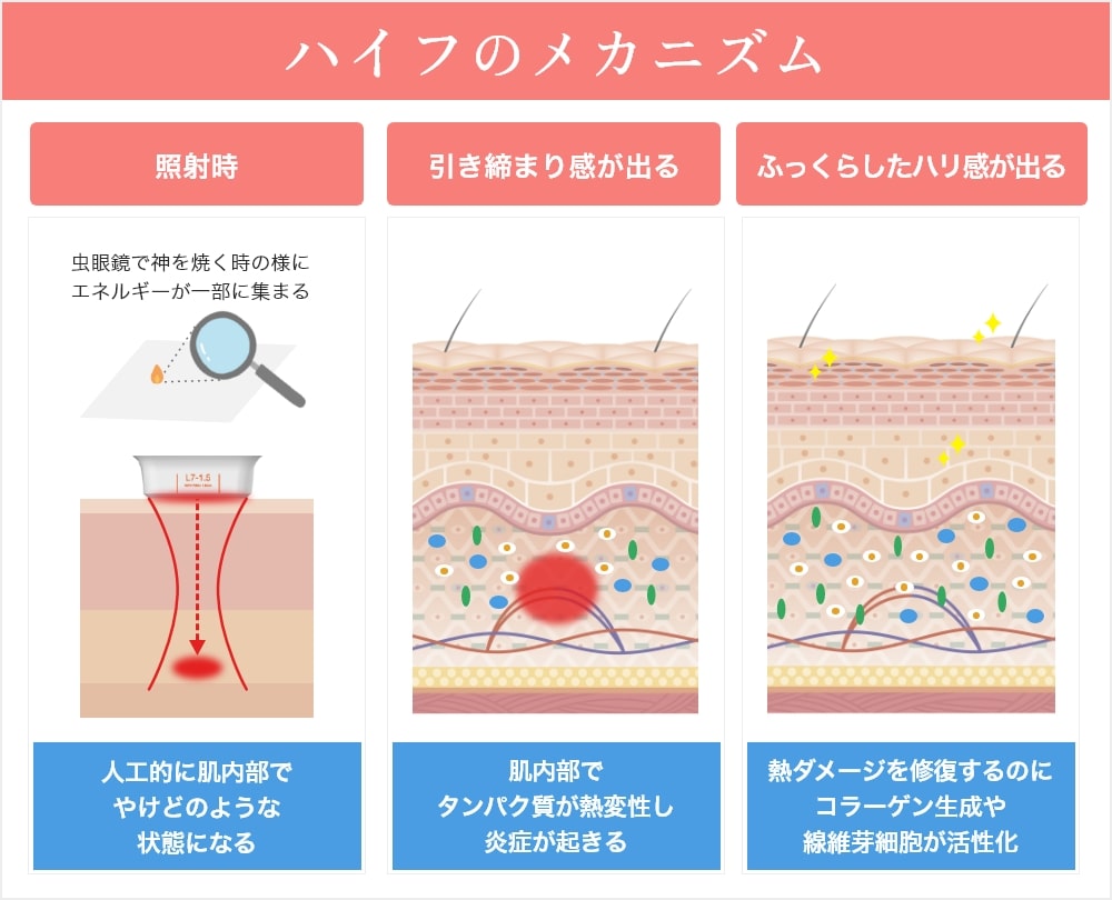 ハイフ