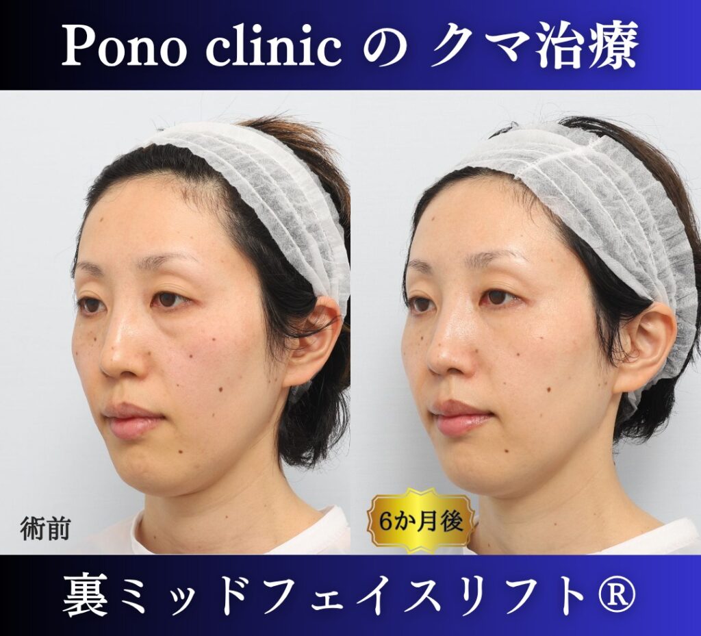 30代女性、目の下のクマ、裏ハムラ、ミッドフェイスリフト、クマ取り (3)