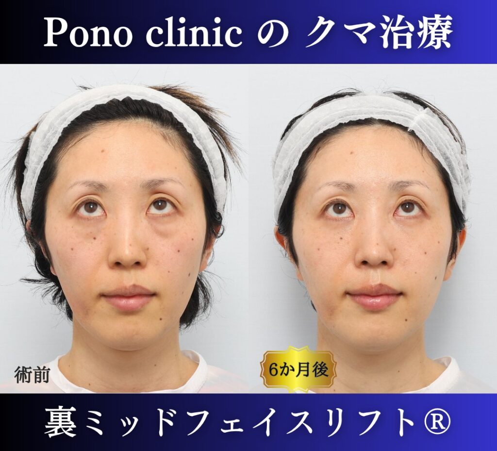 30代女性、目の下のクマ、裏ハムラ、ミッドフェイスリフト、クマ取り (5)