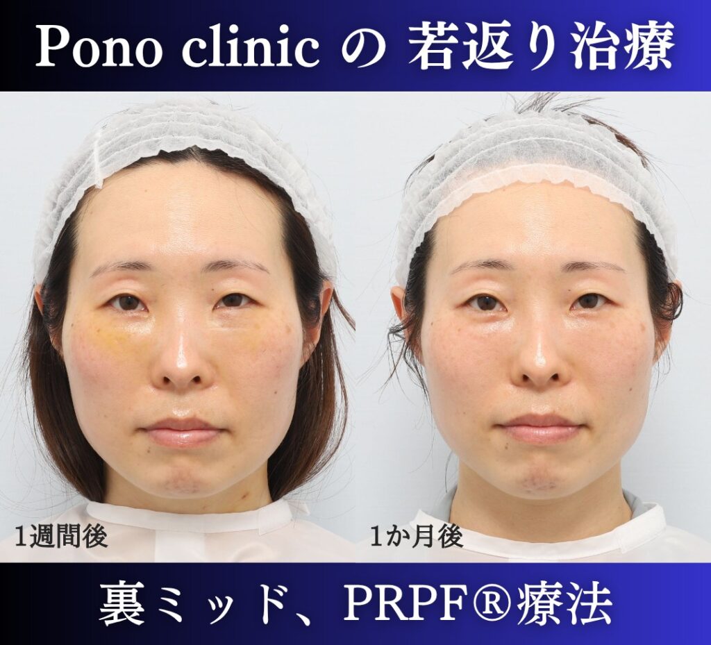 40代女性、目の下のクマ取り、裏ハムラ、ミッドフェイスリフト、法令線治療、しわ治療 (1)