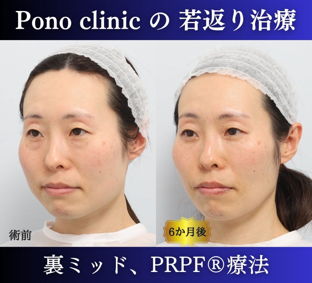 40代女性、目の下のクマ取り、裏ハムラ、ミッドフェイスリフト、法令線治療、しわ治療 (3)