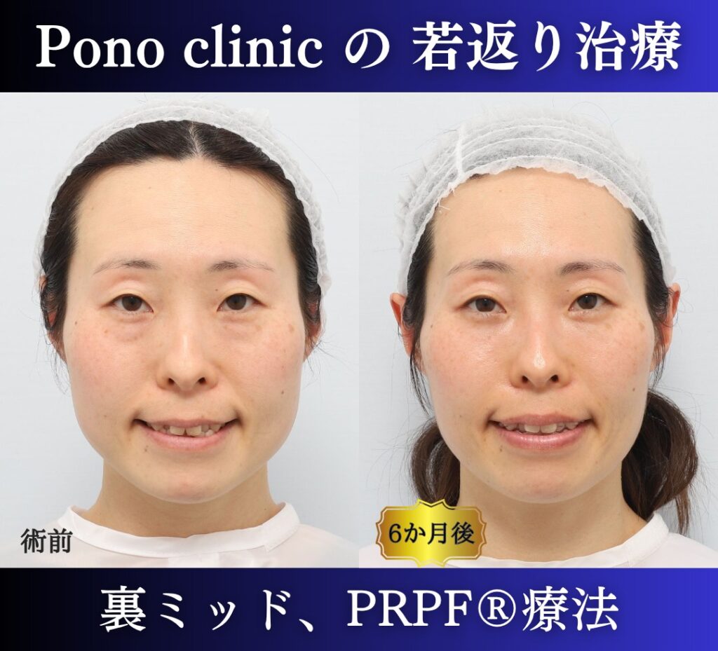 40代女性、目の下のクマ取り、裏ハムラ、ミッドフェイスリフト、法令線治療、しわ治療 (4)