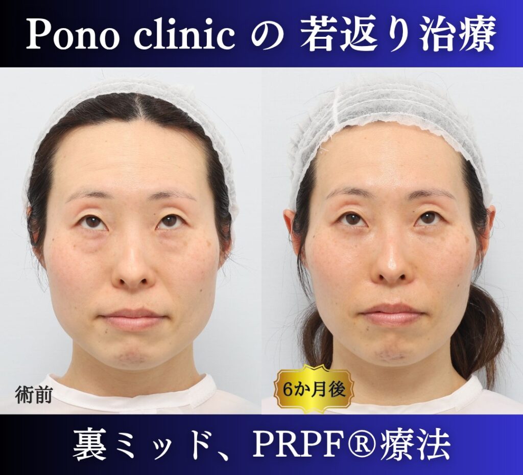 40代女性、目の下のクマ取り、裏ハムラ、ミッドフェイスリフト、法令線治療、しわ治療 (5)