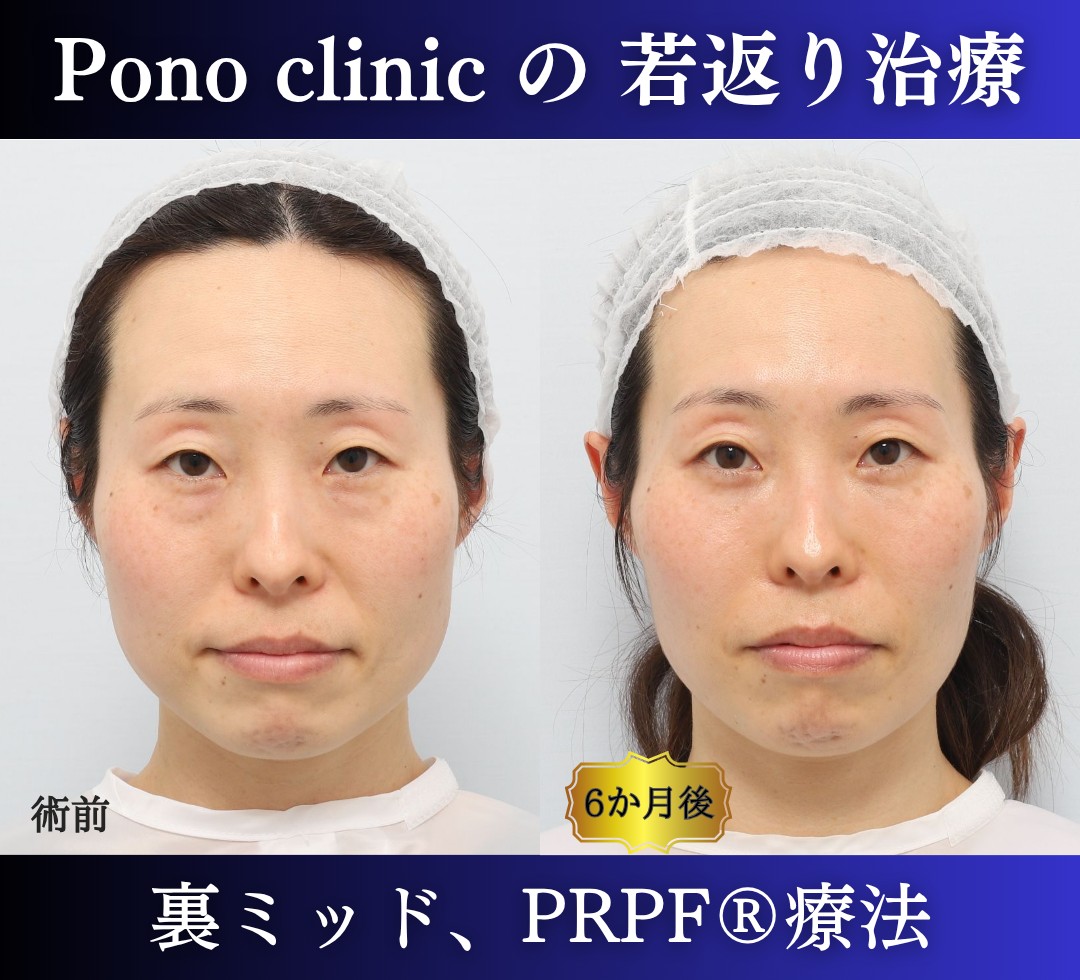 40代女性、目の下のクマ取り、裏ハムラ、ミッドフェイスリフト、法令線治療、しわ治療 (7)