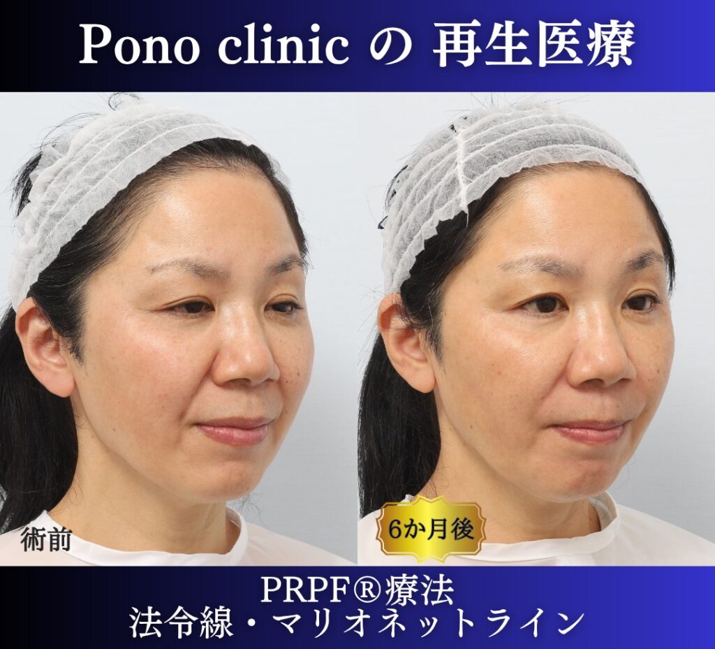50代女性、しわ治療、法令線、マリオネットライン、PRPF療法 (1)