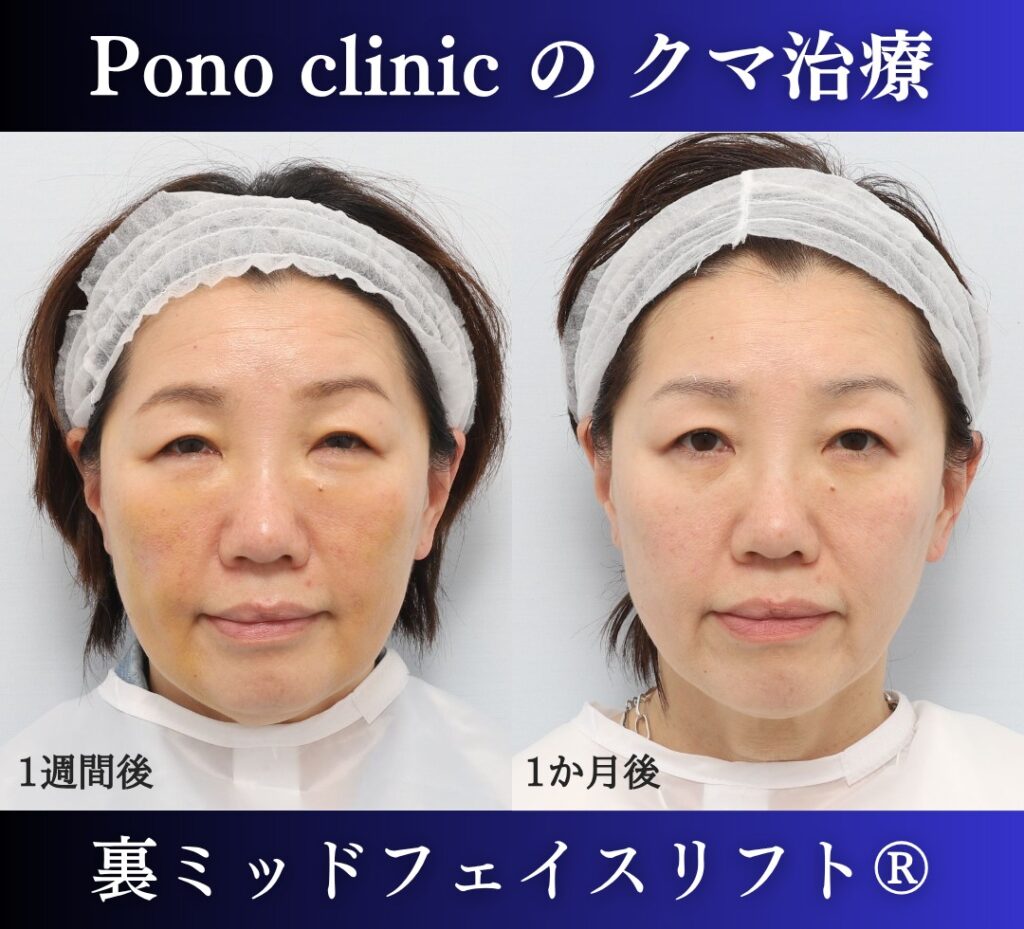 50代女性、目の下のクマ取り、裏ハムラ、ミッドフェイスリフト (1)