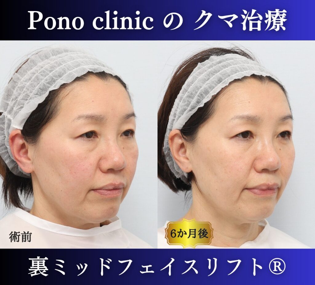 50代女性、目の下のクマ取り、裏ハムラ、ミッドフェイスリフト (2)