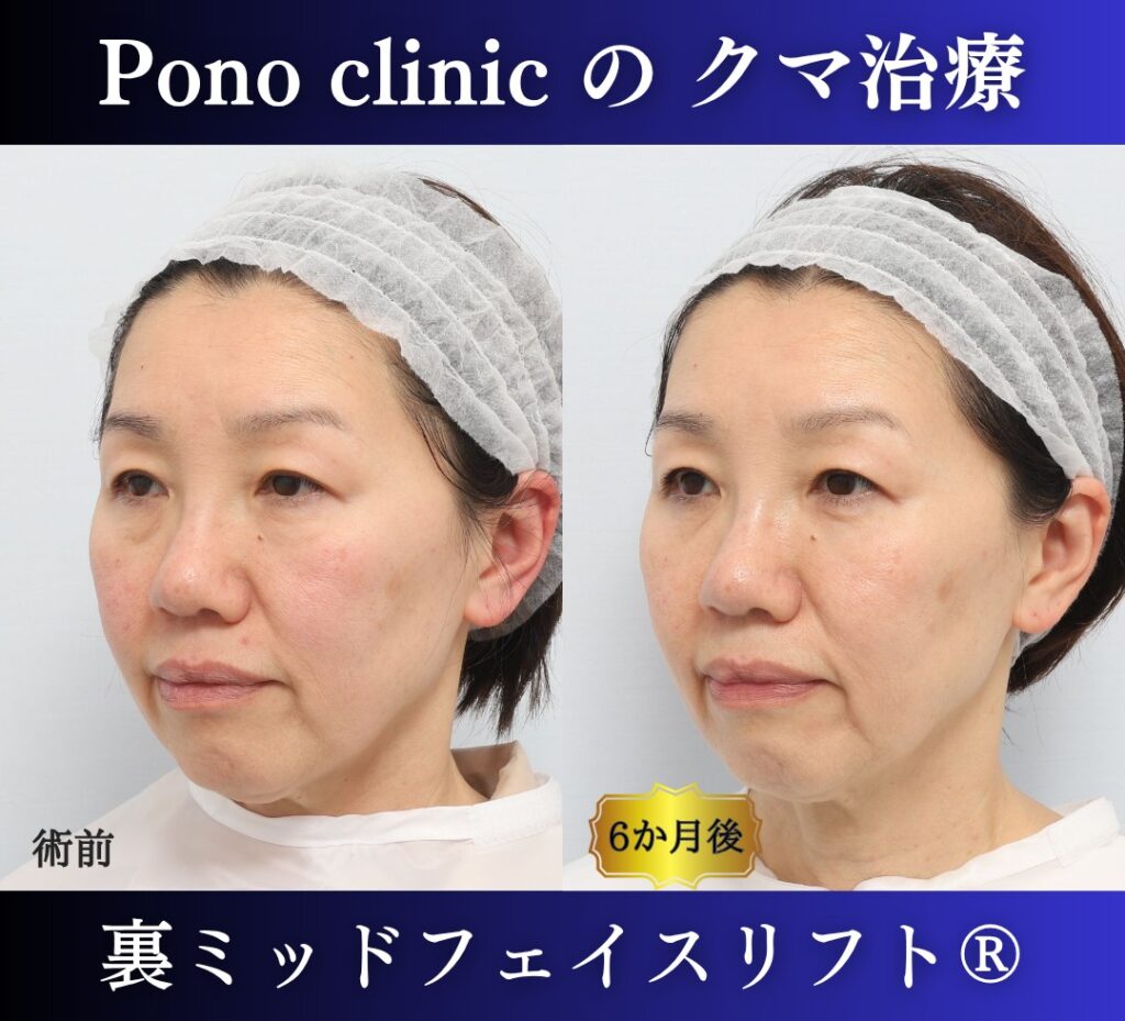 50代女性、目の下のクマ取り、裏ハムラ、ミッドフェイスリフト (3)
